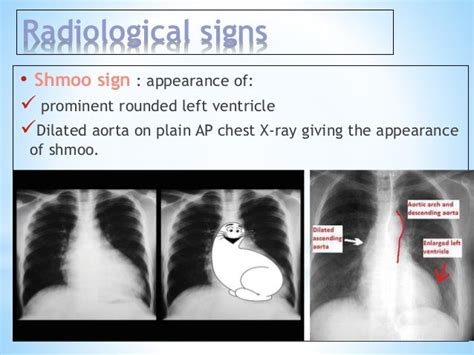 left ventricular enlargement imaging